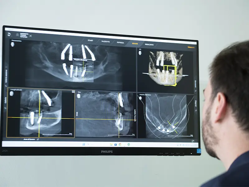 Baragazza - Impianti dentali