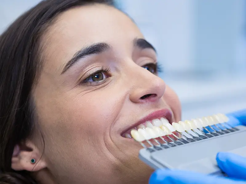 Baragazza - Faccette dentali