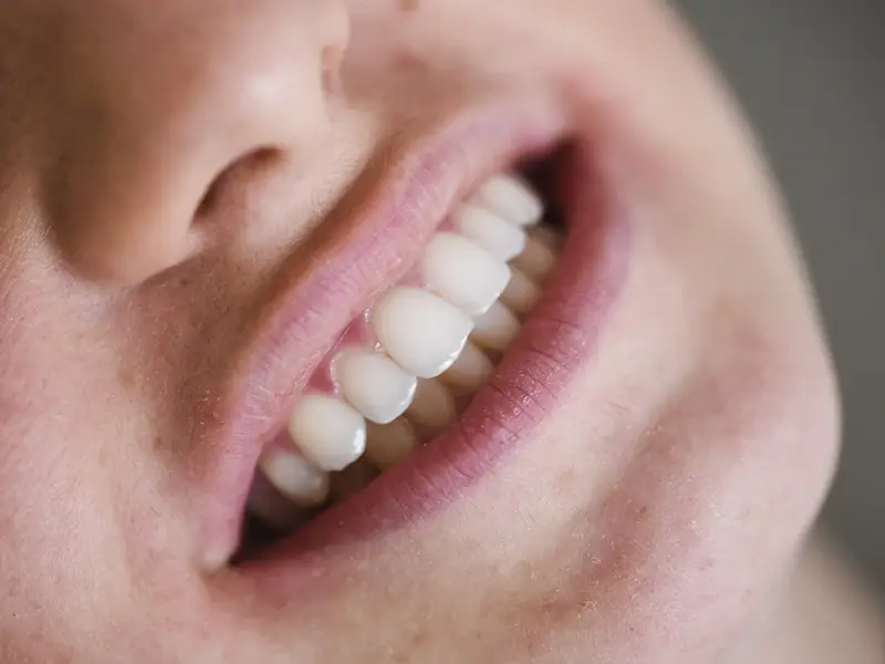 Baragazza - Faccette dentali