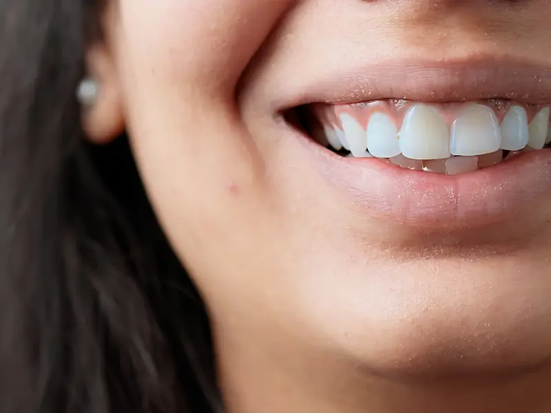 Baragazza - Faccette dentali