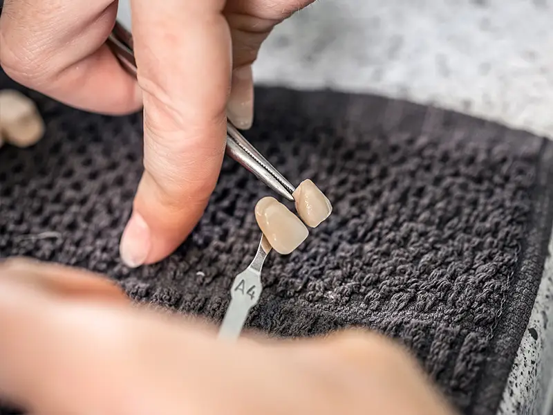 Baragazza - Faccette dentali realizzazione